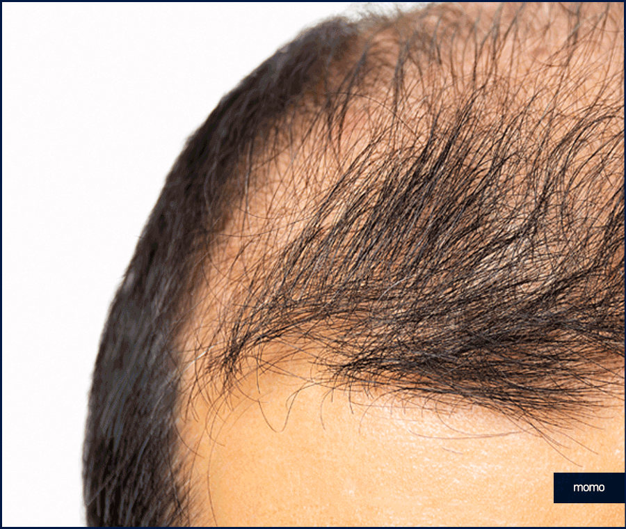 모발이식전후 확인 중이라면 꼭 체크할 핵심 요소 관련 이미지 11