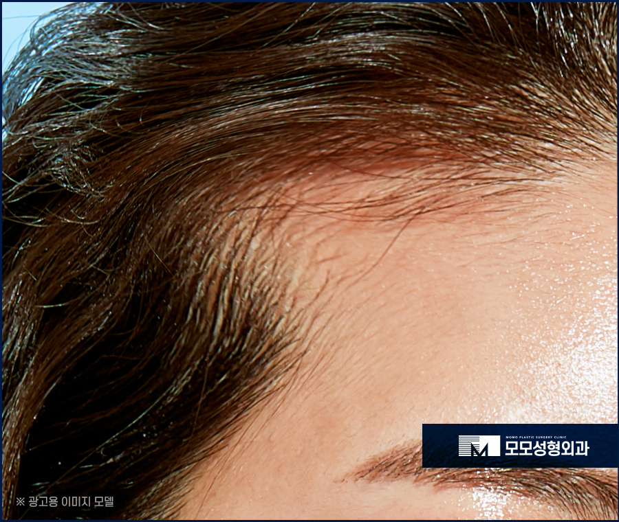 여자엠자탈모 인상까지 변화될 수 있도록 관련 이미지 6