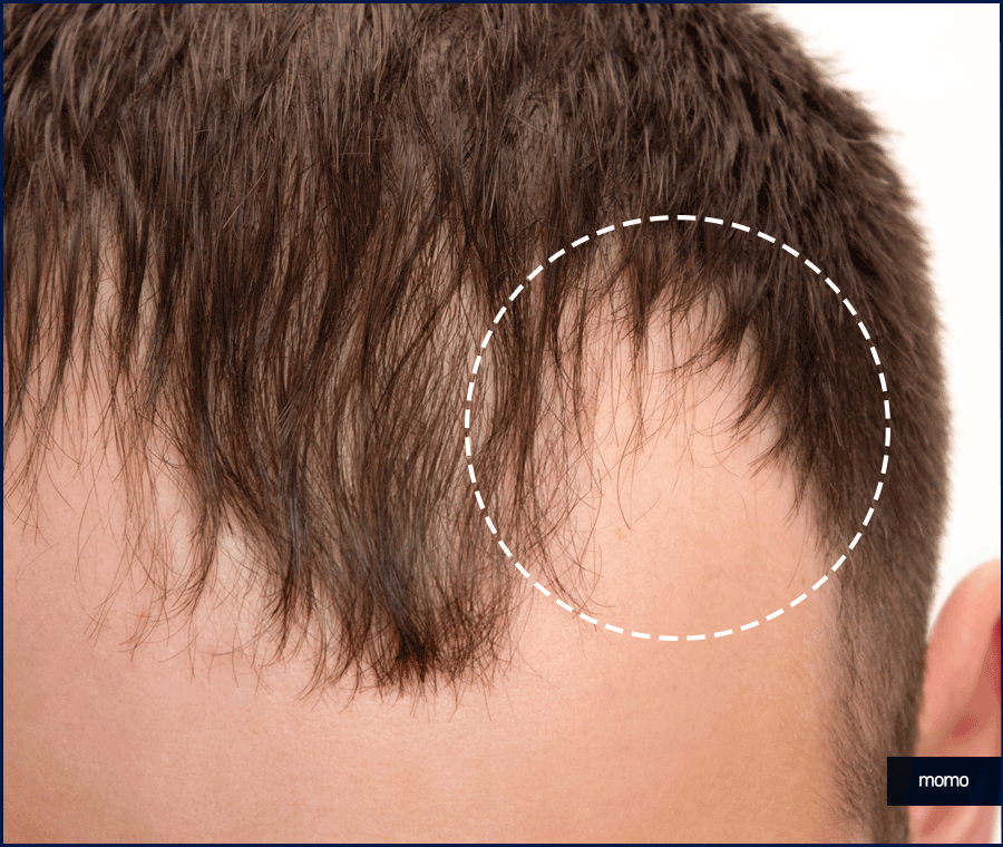 비절개모발이식가격 확인보다 중요한 점 관련 이미지 9