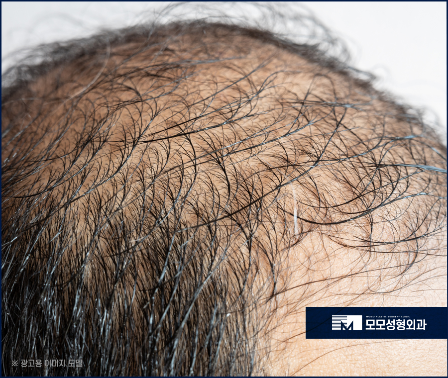 모발이식명의 효과를 위해 찾고 있다면 관련 이미지 2