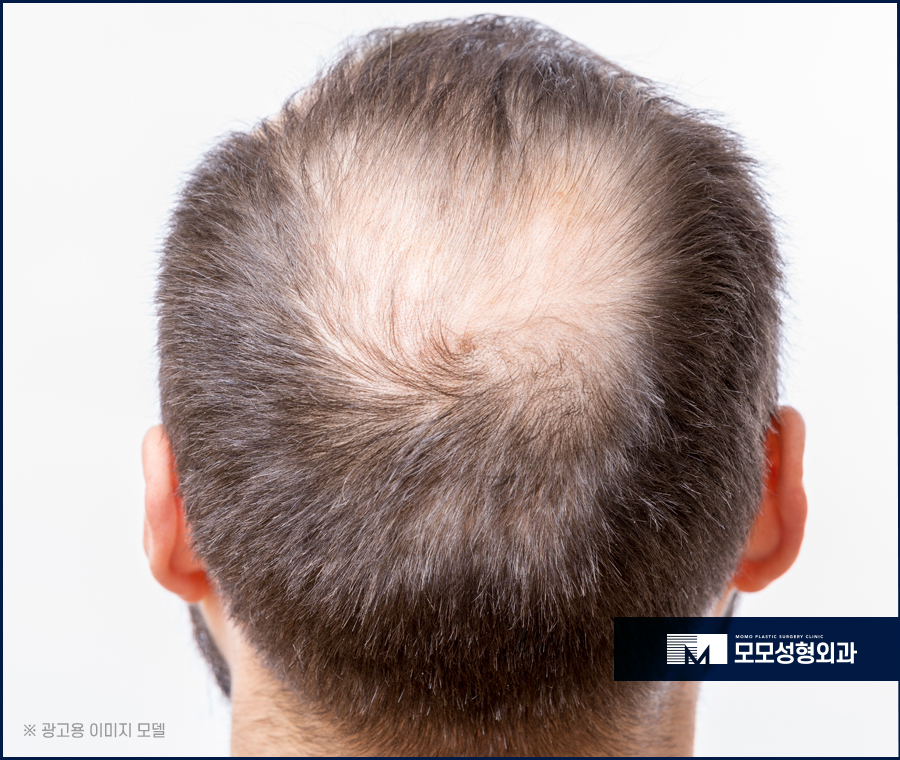 모발이식5000모 상태에 맞는 진단으로 관련 이미지 2