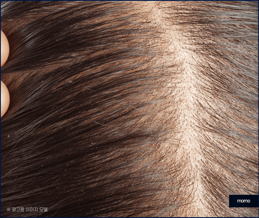 여자 가르마 탈모 모발이식으로 효과보려면? 관련 이미지 11