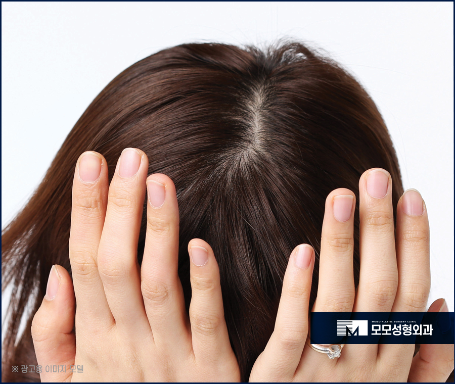 여자가르마탈모 수복을 위한 시술은 관련 이미지 5