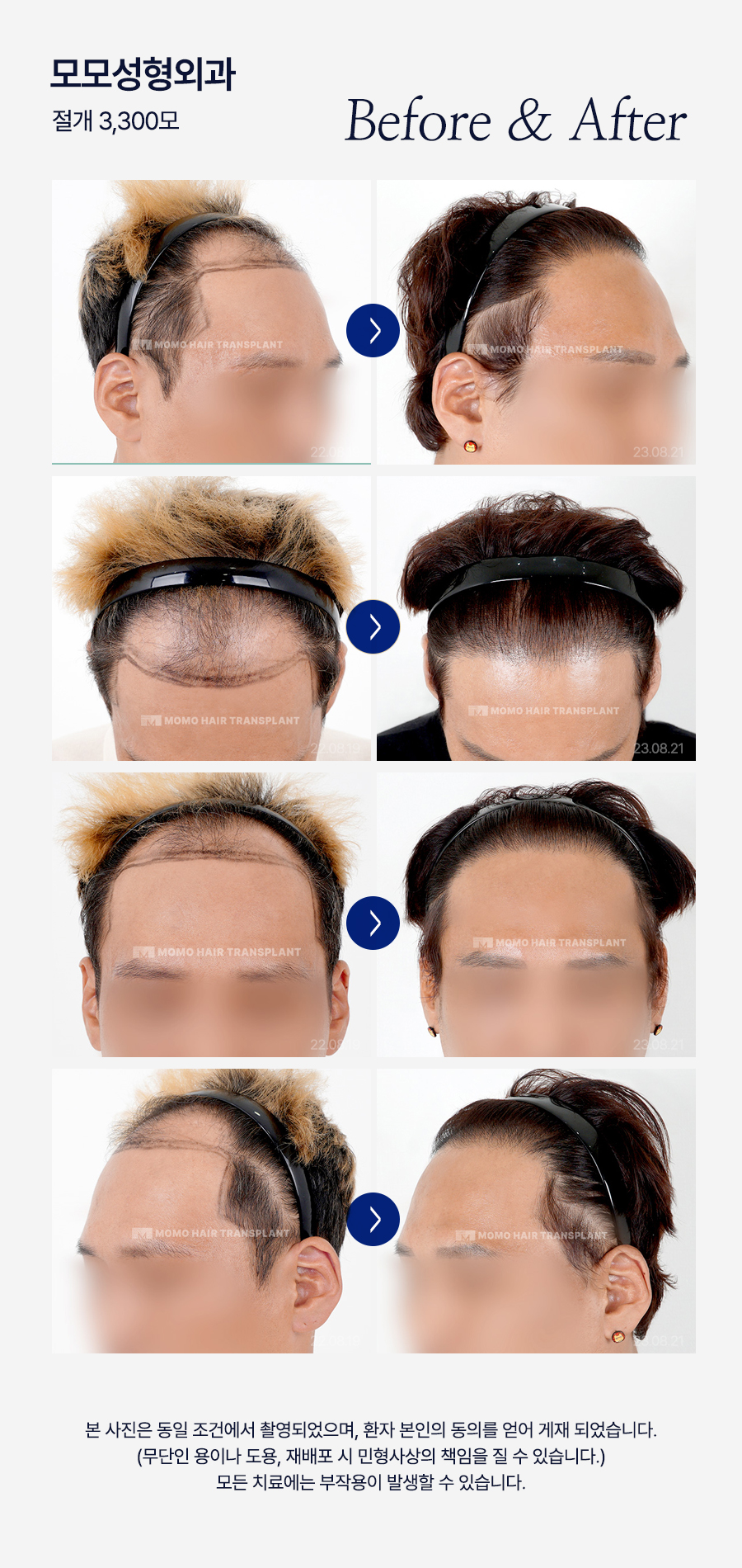 엠자 탈모 섬세하게 채워 만드는 변화 관련 이미지 17