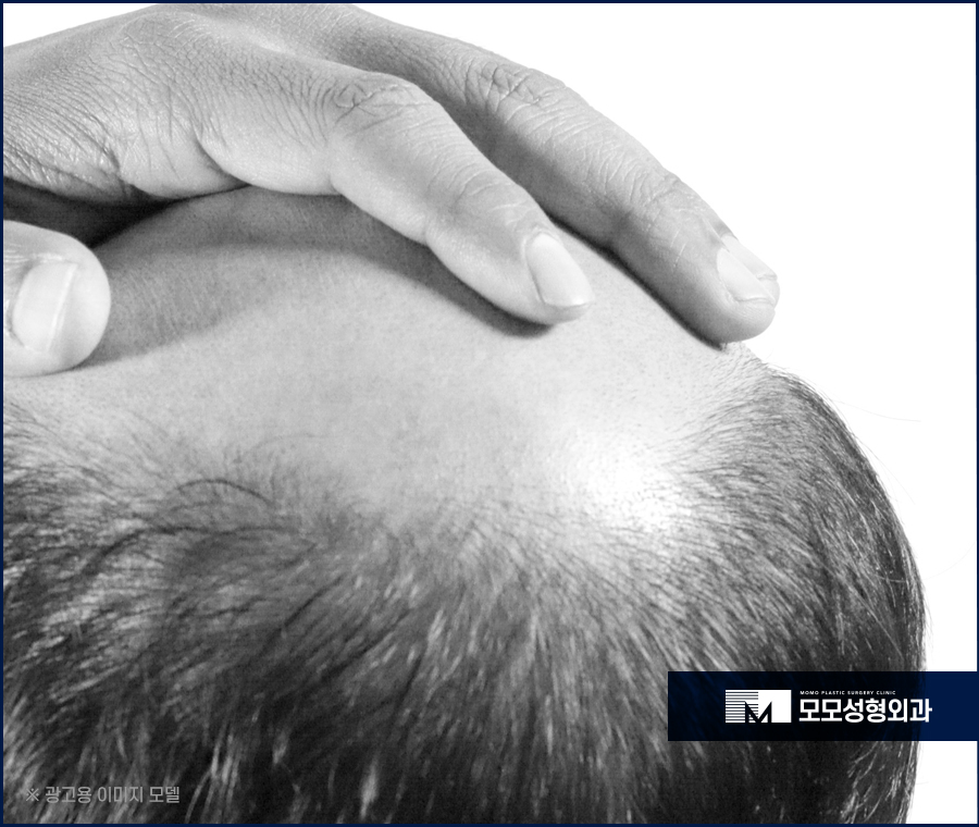압구정 모발이식 안정적인 생착을 만드는 관련 이미지 4