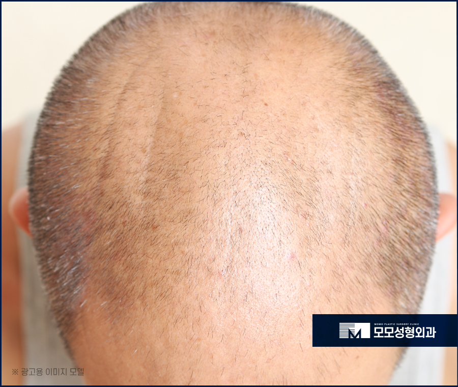모발이식생착률 높여가는 과정을 통해 관련 이미지 3