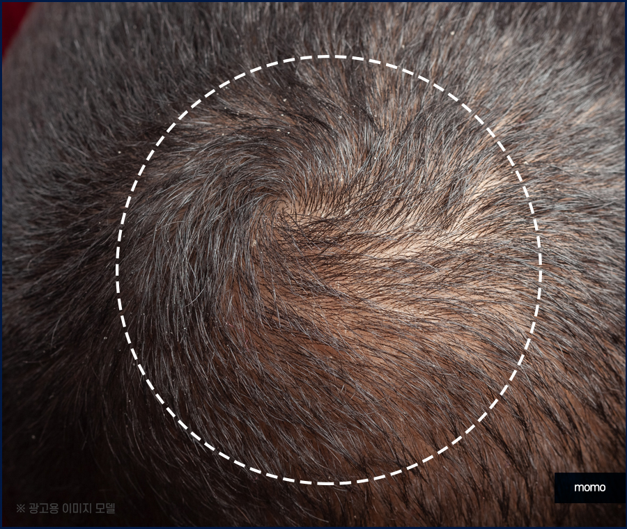 머리심기비용이 달라지는 이유와 차이점 관련 이미지 12