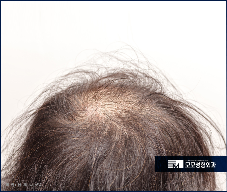 모발이식3000모 꼼꼼하게 심기 위한 관련 이미지 2