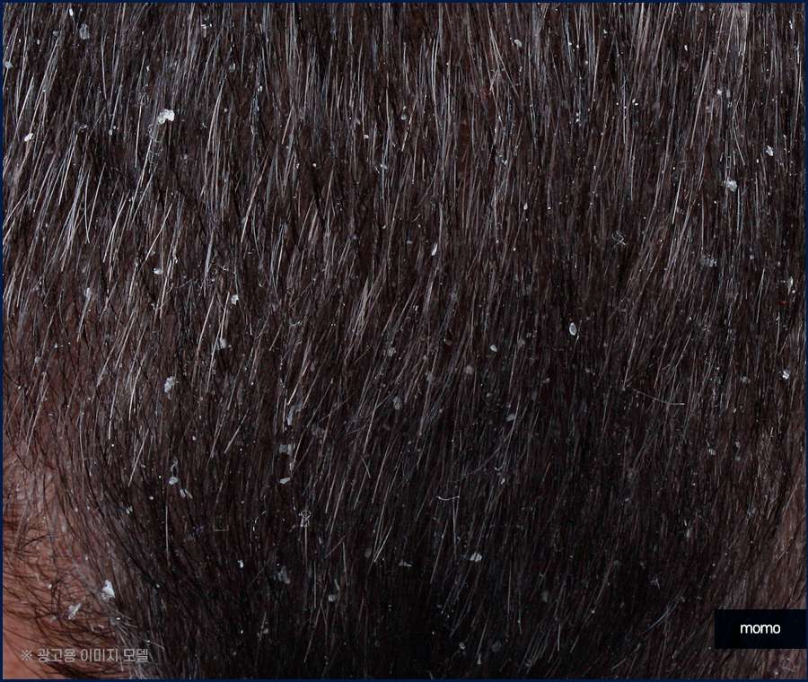 머리비듬없애는법 효과적인 비결에 대해 관련 이미지 3