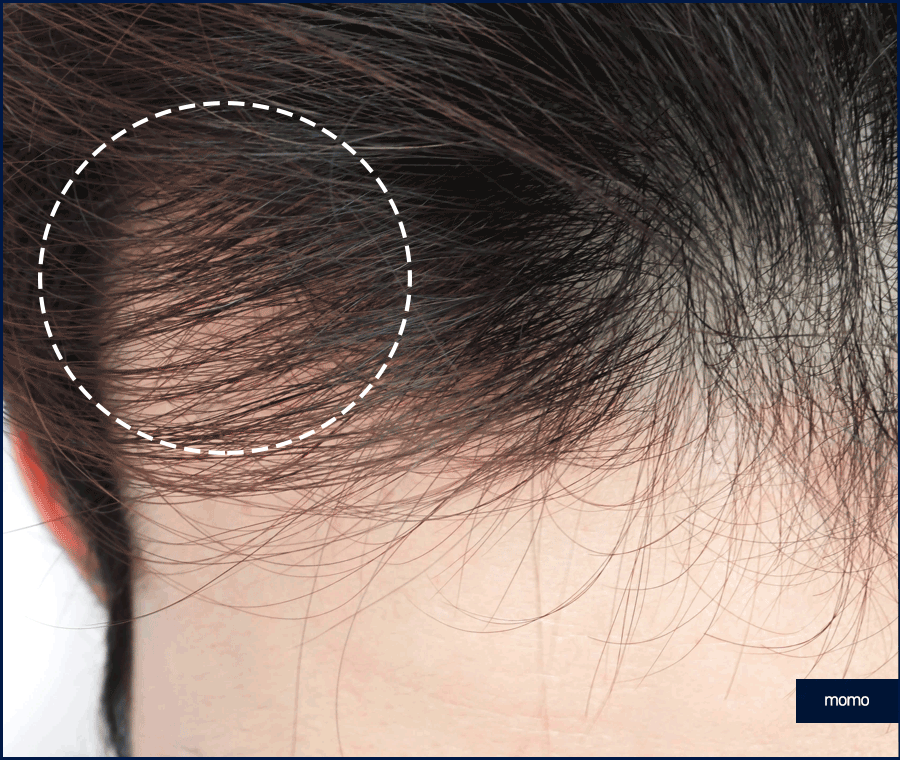 M자탈모치료 모발이식이 특별한 이유 3가지 관련 이미지 7