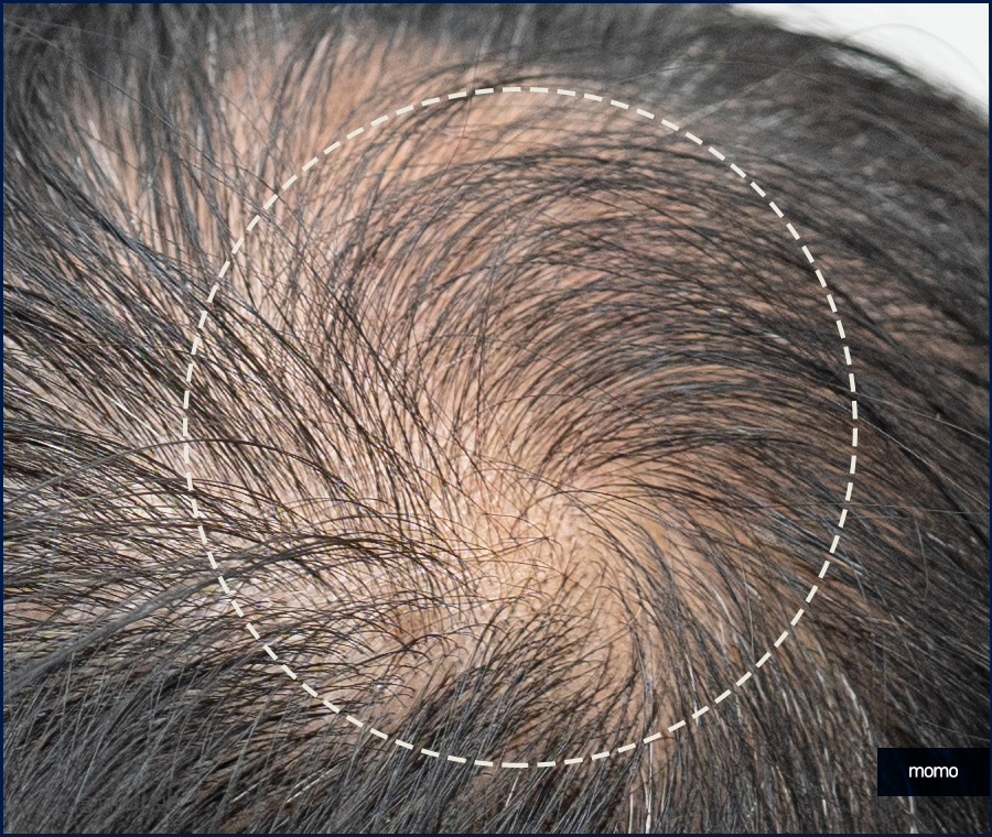 머리심기비용이 달라지는 이유와 차이점 관련 이미지 10