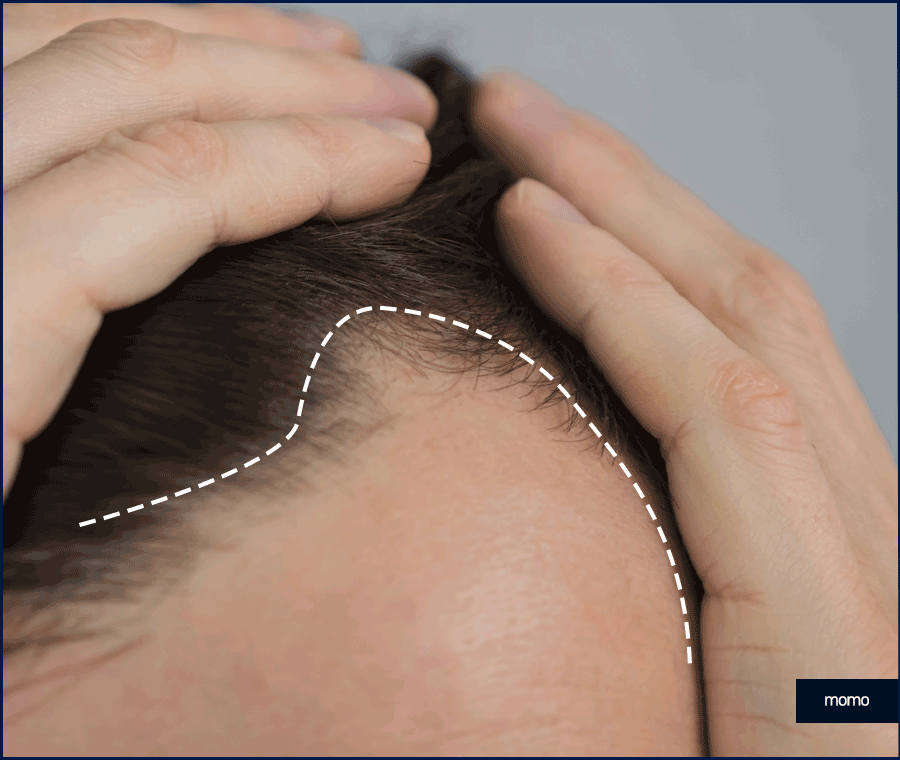 여자M자탈모 회복을 위한 맞춤 솔루션 관련 이미지 6