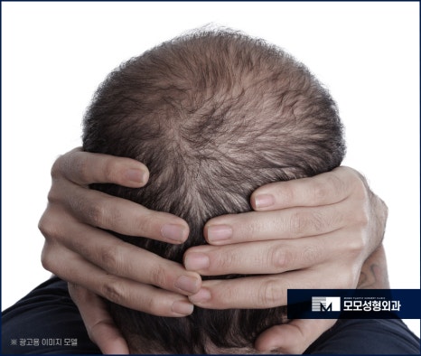 남자머리심기 신속한 일상 회복을 위한 방법 (ft. 비절개모발이식) 관련 이미지 10