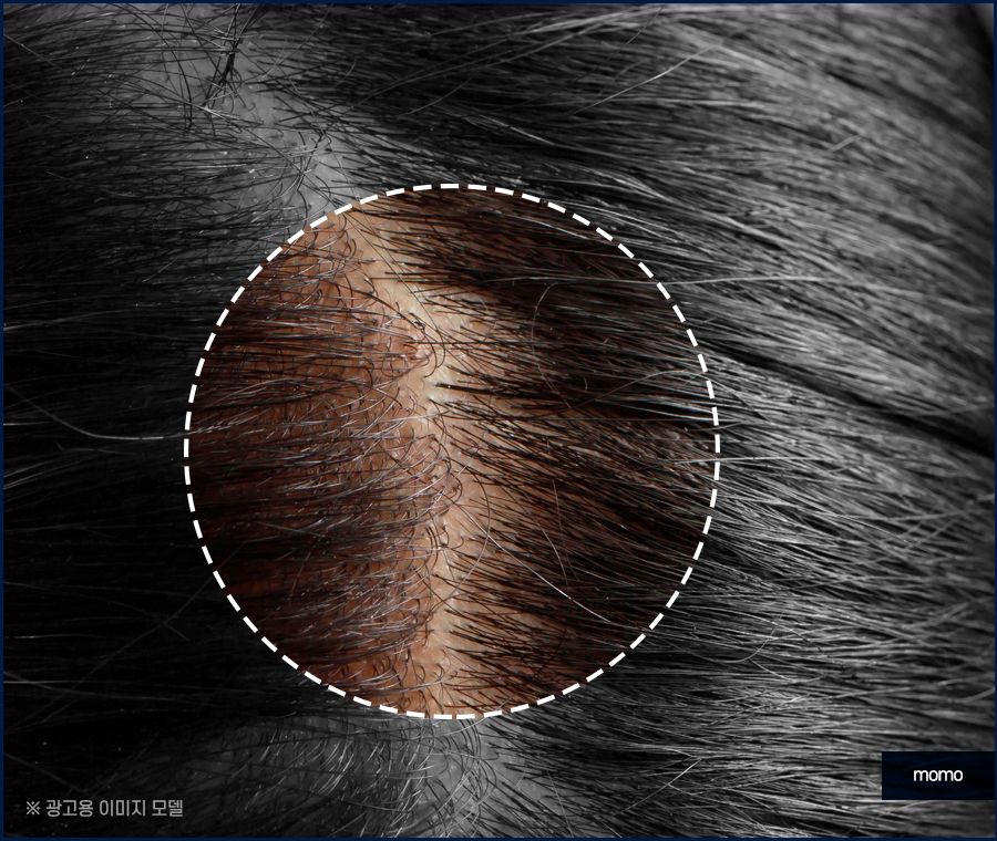 남자 가르마 탈모 고민을 끝내기 위한 방안은 관련 이미지 3