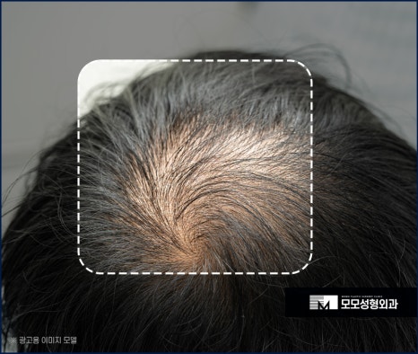 신사역 모발이식 디자인이 중요시 여겨지는 이유 관련 이미지 4