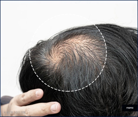 압구정 모발이식 외모 변화를 희망한다면 관련 이미지 8