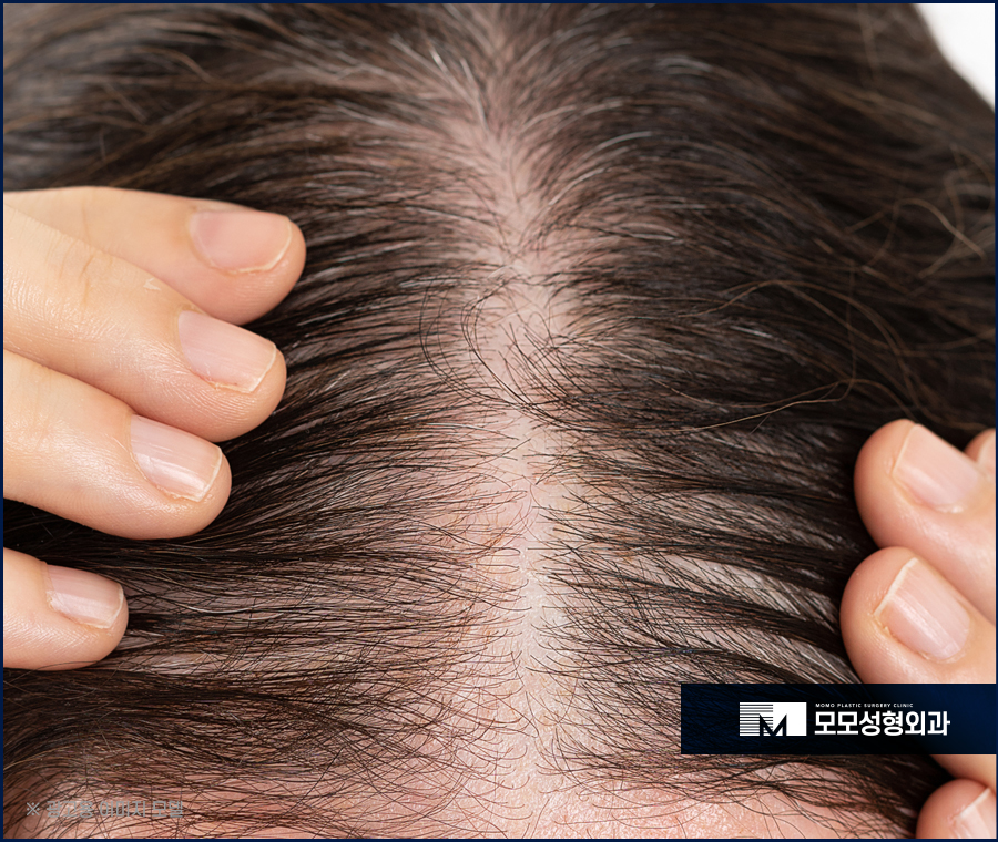 20대 여자 가르마 탈모 빠른 대응이 중요한 이유 관련 이미지 5