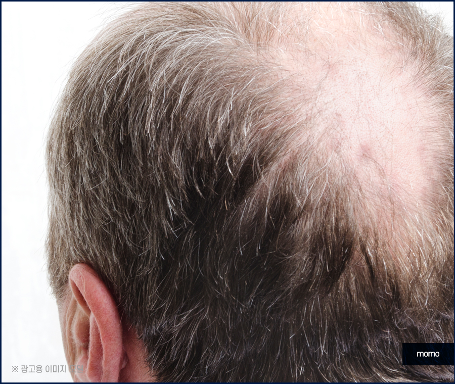 대량 모발이식 확연한 변화를 위해서 관련 이미지 6