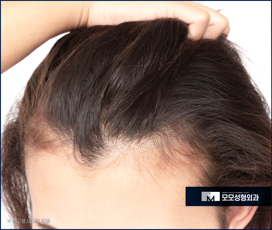 모발이식2달 차에 일어나는 달라짐에 대해서 관련 이미지 3