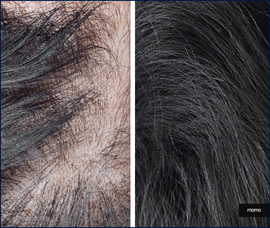 압구정 탈모병원 보완을 위한 최선책은? 관련 이미지 4