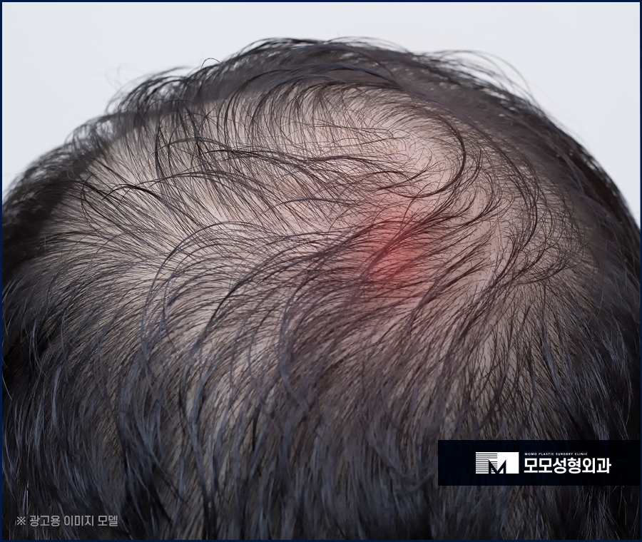 두피모낭염 증상 및 완화를 위한 방법에 대해서 관련 이미지 3