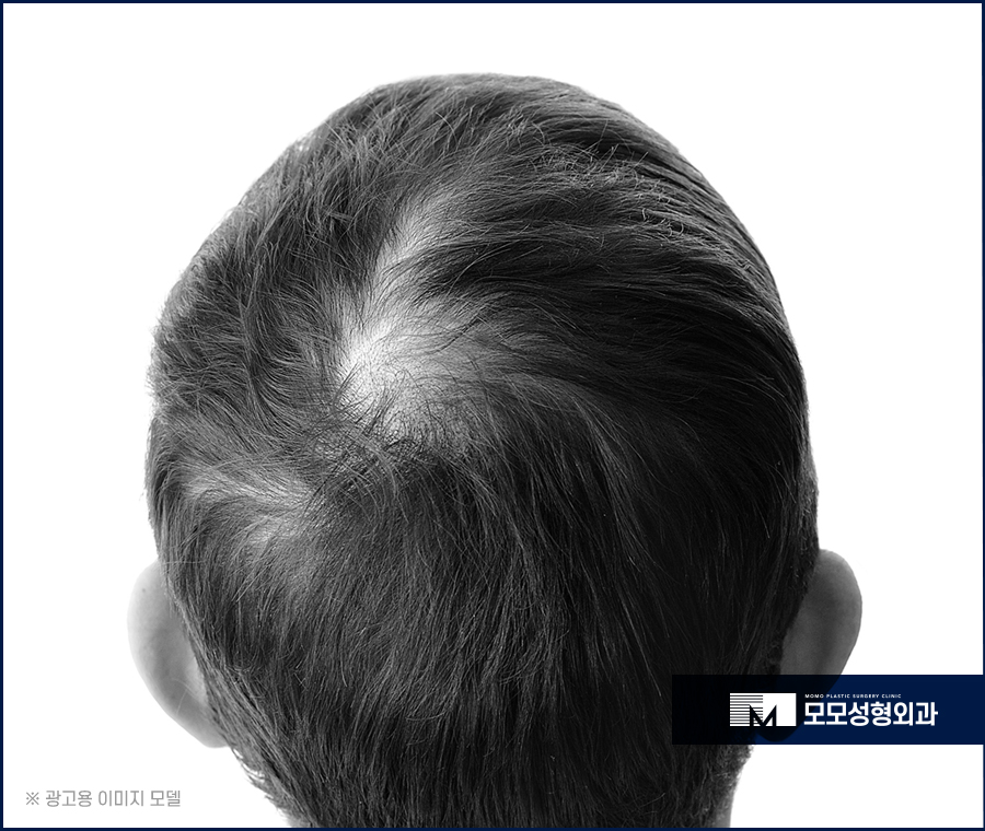 정수리모발이식비용 얼굴 이미지를 고려하며 관련 이미지 2