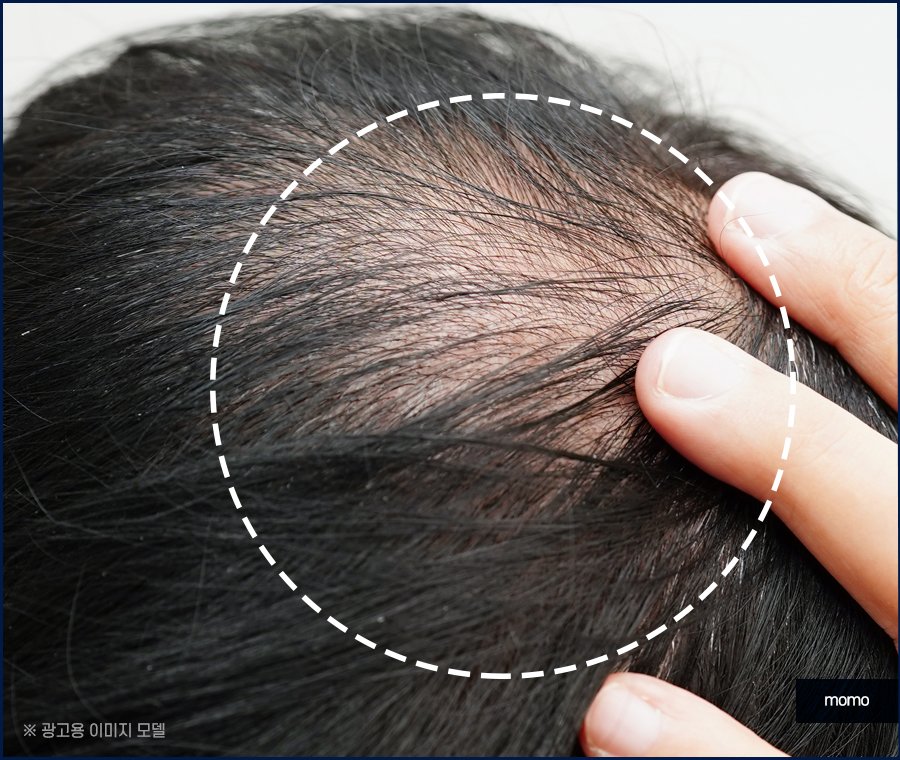 압구정 모발이식 건강한 두피를 만드는 방법 관련 이미지 8