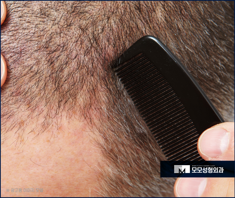 남자 앞머리 탈모 M자 라인 깊어짐이 보인다면 관련 이미지 7
