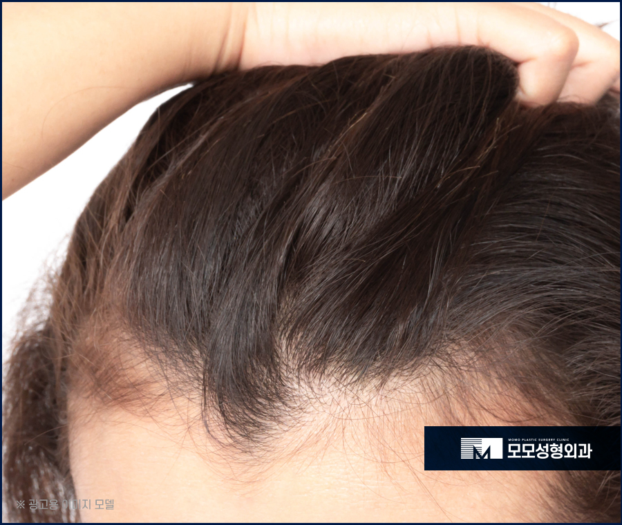 남자헤어라인교정 반듯함으로 완성하는 외모 관련 이미지 2