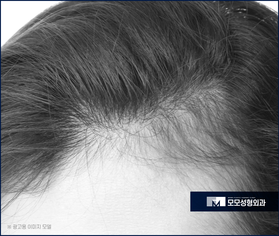 여자 헤어라인 모발이식 부작용 발생 우려를 낮춰야만 관련 이미지 7