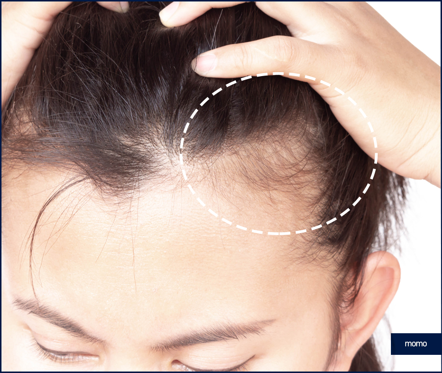 M자모발이식비용 가격 탈모 탈출을 위한 관련 이미지 9