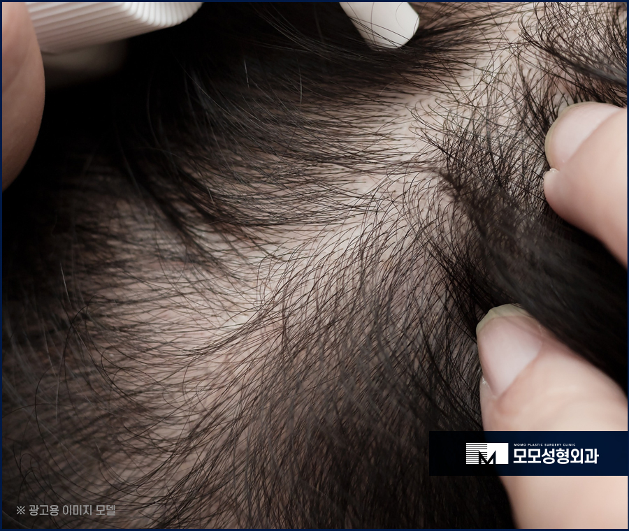 가르마모발이식 하얗게 보이던 부분을 채워서 관련 이미지 5