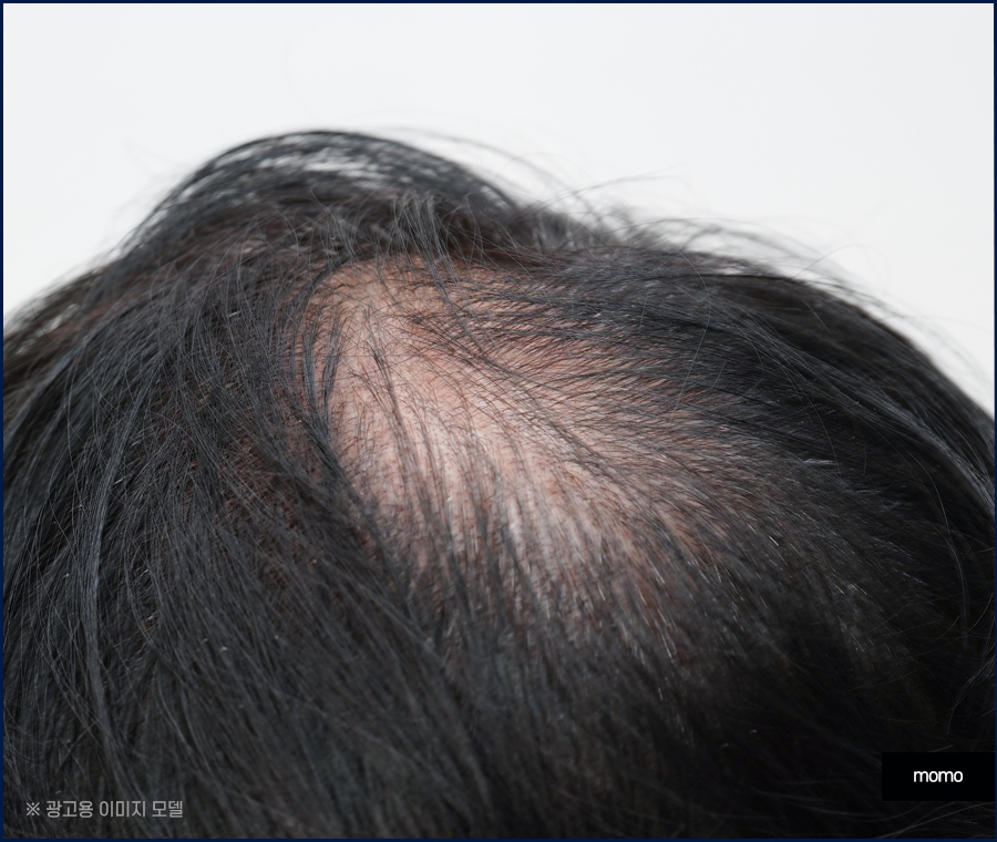 모발이식 생착률 극대화 하려면 관련 이미지 4