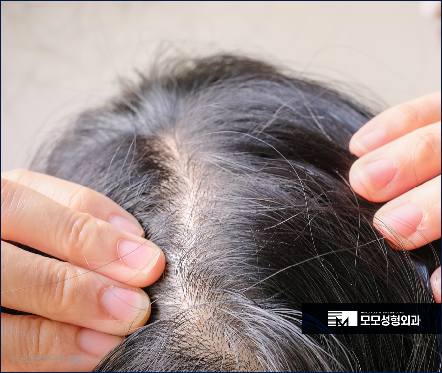 여성 옆머리 탈모 증상이 보여질 경우 해결 방법은 관련 이미지 4