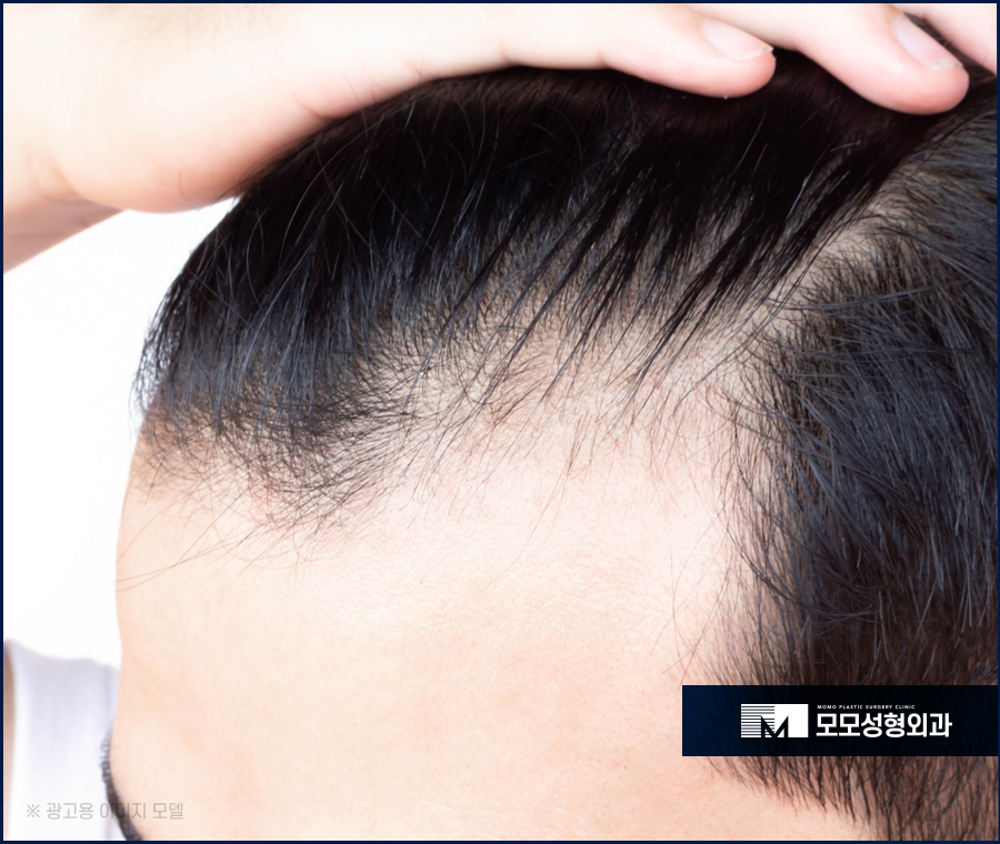 탈모전조증상 미리 알 수 있는 부분은 관련 이미지 7