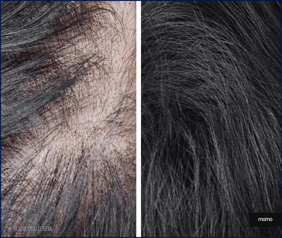 모발이식 생착률 높이기 위한 솔루션은 관련 이미지 7