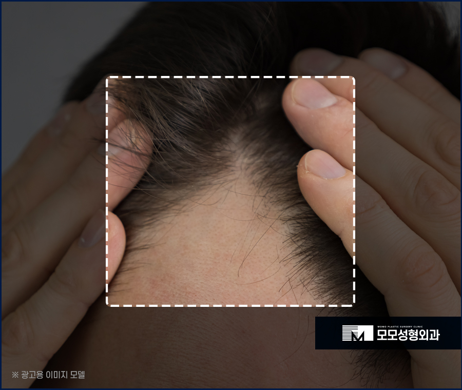 모발이식 삭발이 싫다면 노컷으로 부담을 줄여서 관련 이미지 3