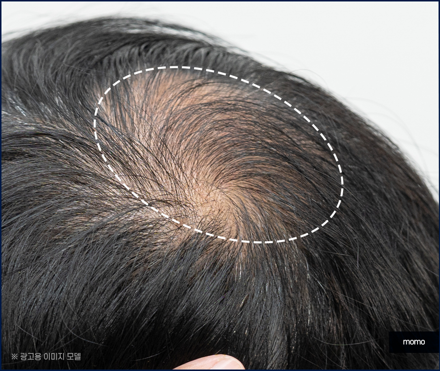 모발이식잘하는곳 찾는 결정적인 기준 관련 이미지 11