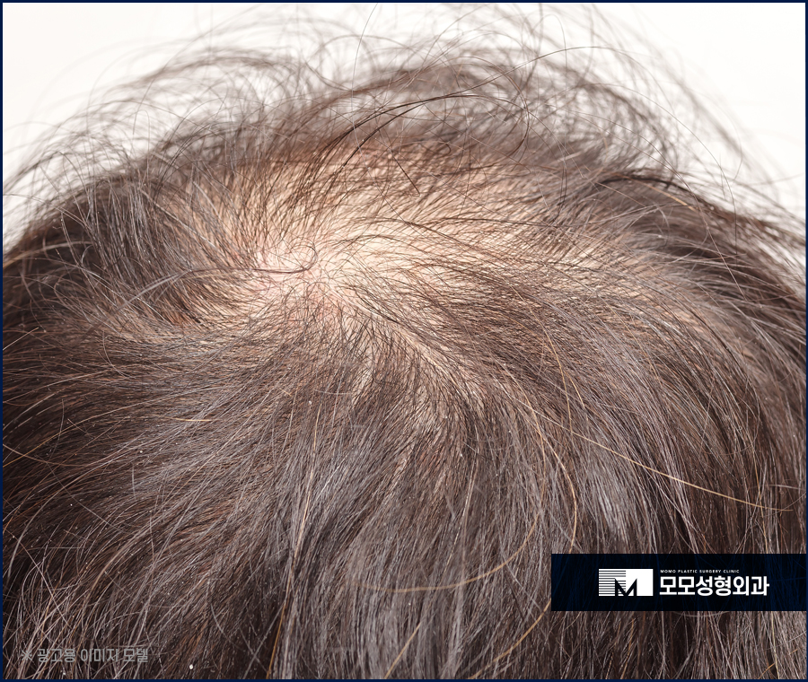 안드로겐성탈모 원인과 개선을 위한 방안은 관련 이미지 9