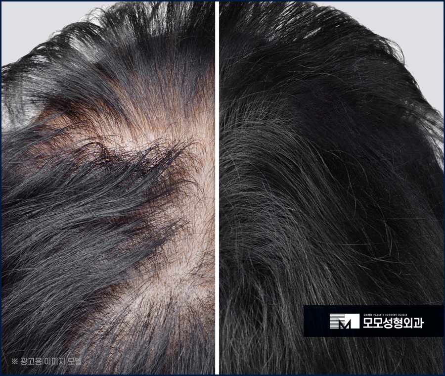 m자탈모모발이식비용 어느 정도가 적절할까요 관련 이미지 4
