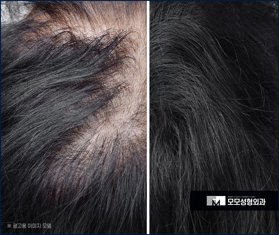 신사역탈모병원 예후가 우수하려면 관련 이미지 4