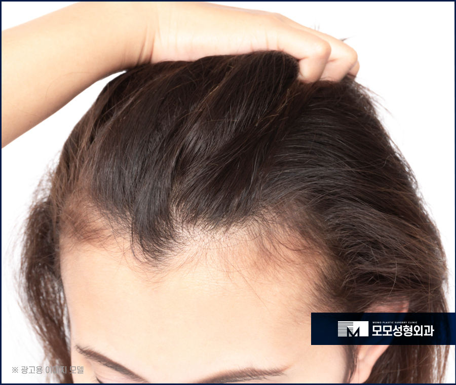 비절개모발이식비용 기준짓는 요소에 관하여 관련 이미지 2
