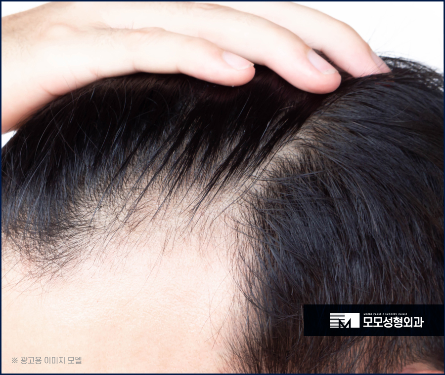 두피가려운이유 원인에 대해서 알아보는 관련 이미지 6