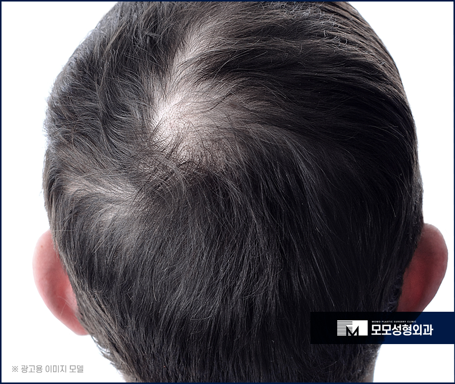 압구정모발이식 결과를 우수하게 만드려면 관련 이미지 3