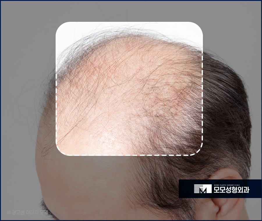 신사역 모발이식 디자인이 중요시 여겨지는 이유 관련 이미지 8