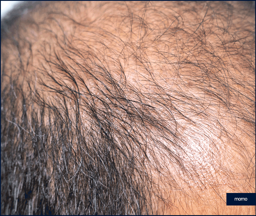 m자탈모병원 모발이식 고민이신 분들이라면 필독 관련 이미지 5