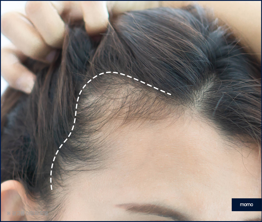 모발이식잘하는곳 찾는 결정적인 기준 관련 이미지 8