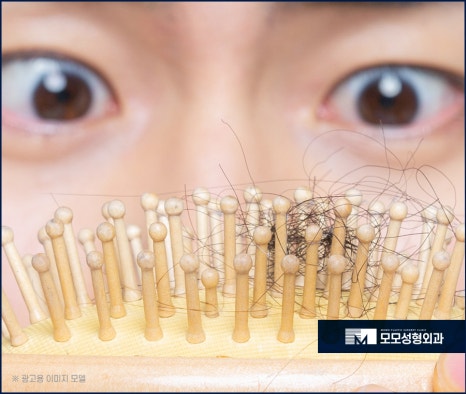 남자머리심기 신속한 일상 회복을 위한 방법 (ft. 비절개모발이식) 관련 이미지 2