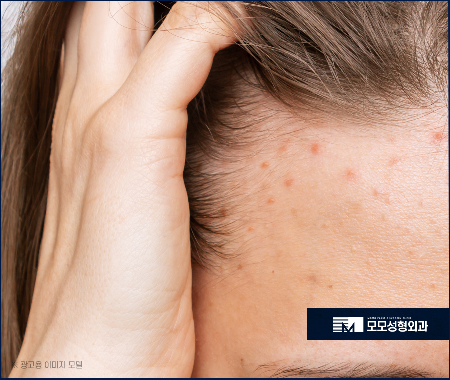 여자M자탈모치료 고민되는 상황에서는 관련 이미지 8