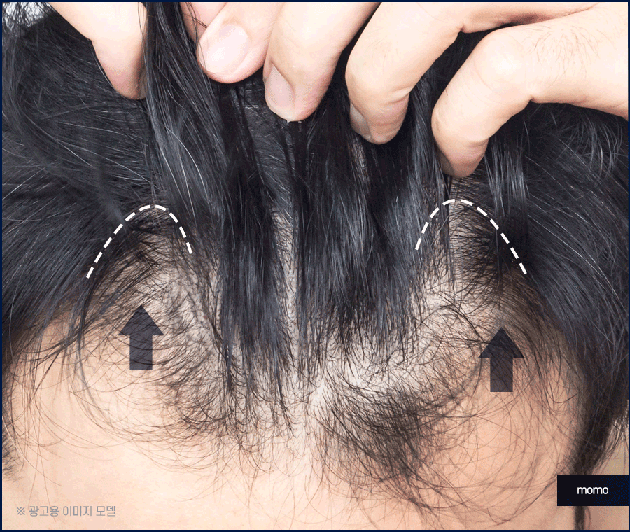 여자M자탈모 회복을 위한 맞춤 솔루션 관련 이미지 9